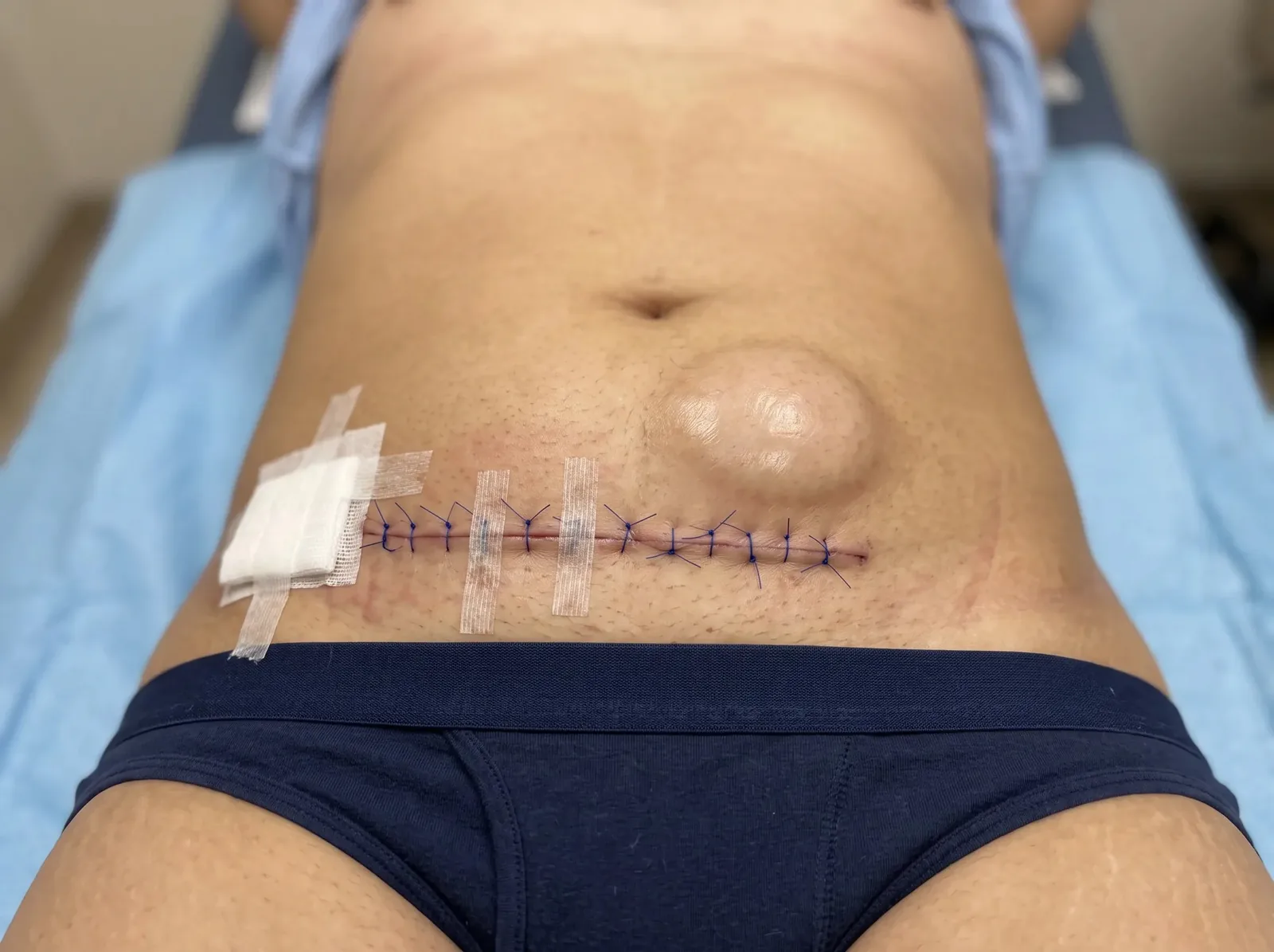 Seroma After Surgery