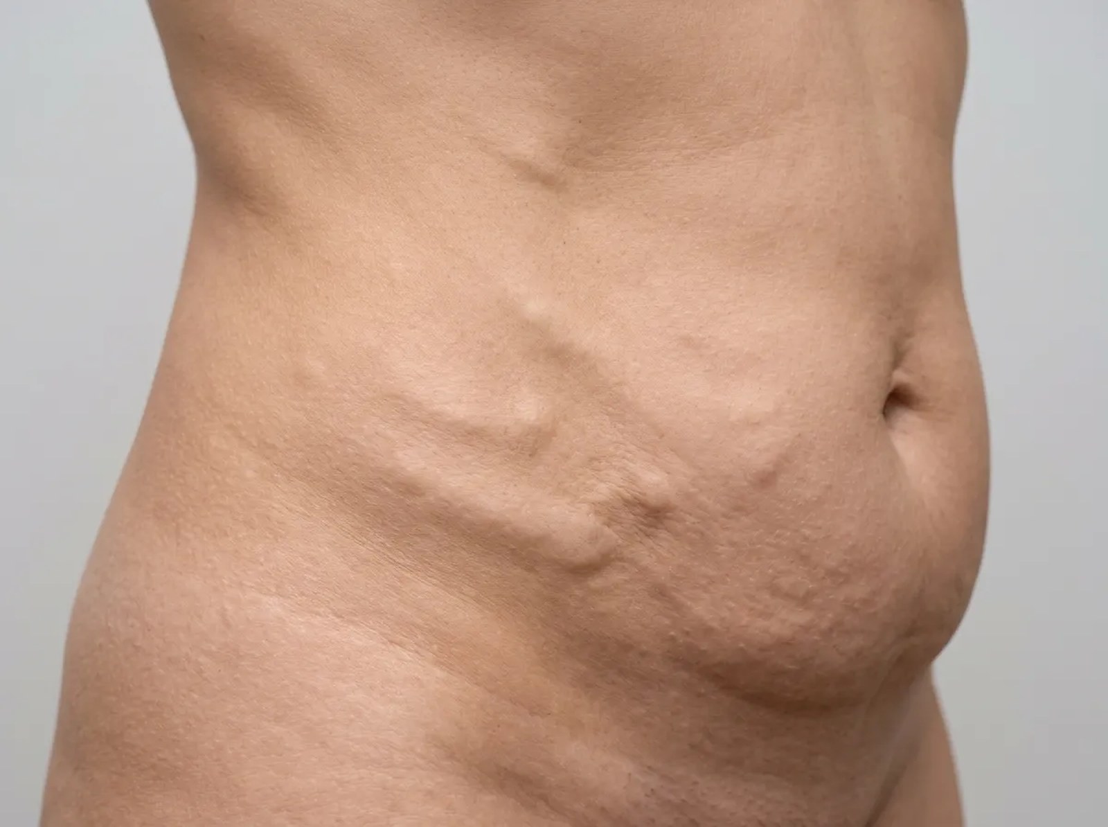 Fibrosis after liposuction