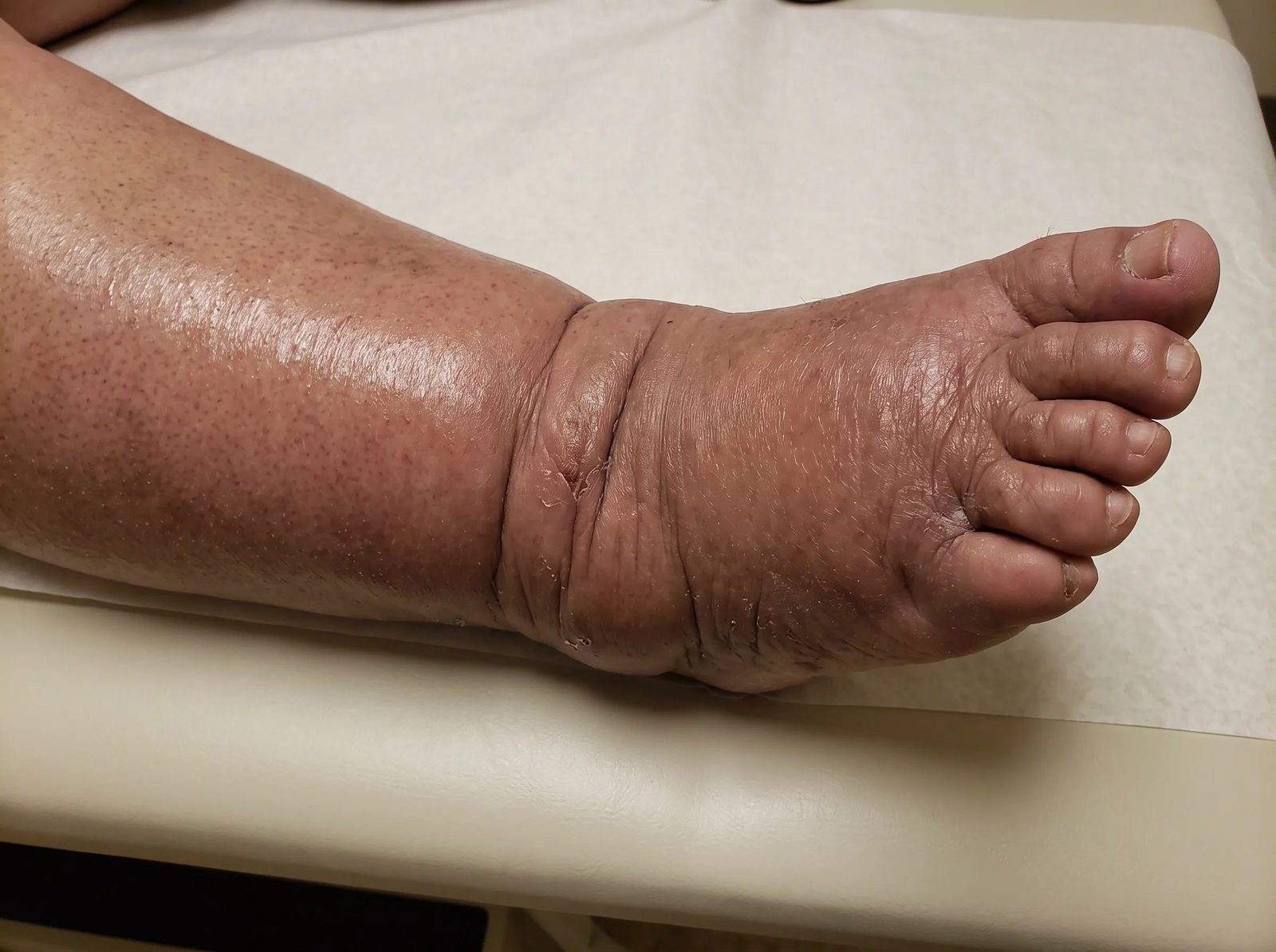 Lymphedema