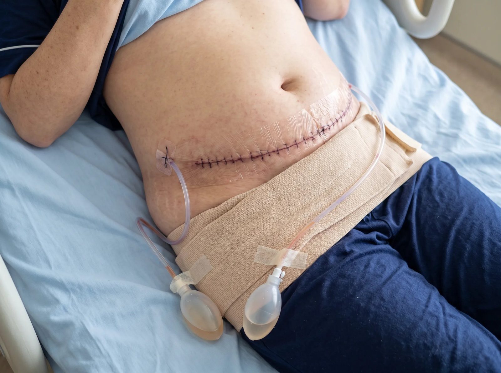 Post-surgical swelling